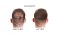 Nanogen "before and after" marketing